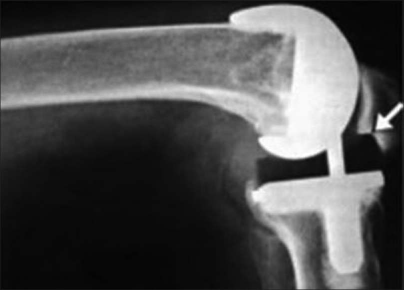 Patellar impingement