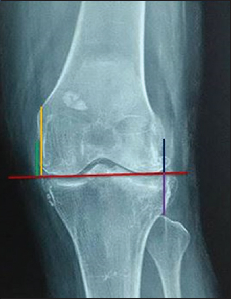 Different tools to measure joint line