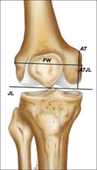 Method to measure adductor ratio (adductor ratio = adductor tubercle joint line/femoral width)