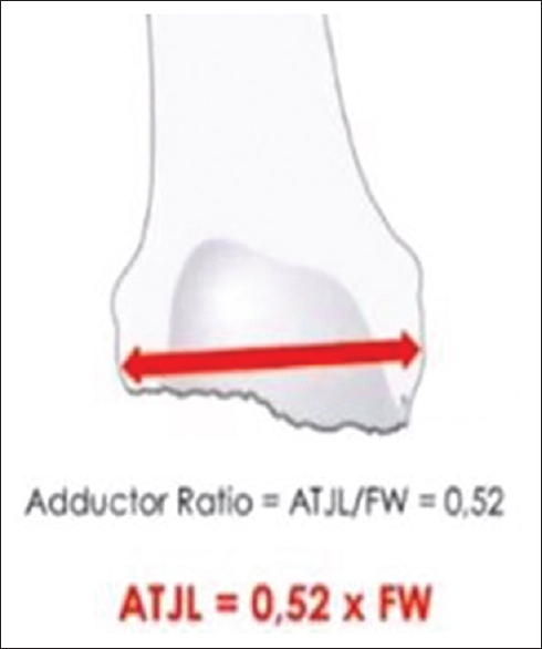 Method to determine adductor tubercle joint line in revision total knee arthroplasty