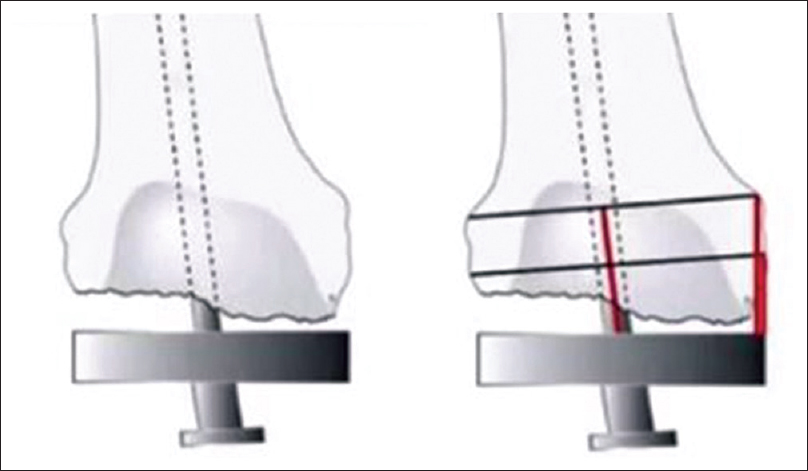 Method to determine joint line in revision total knee arthroplasty