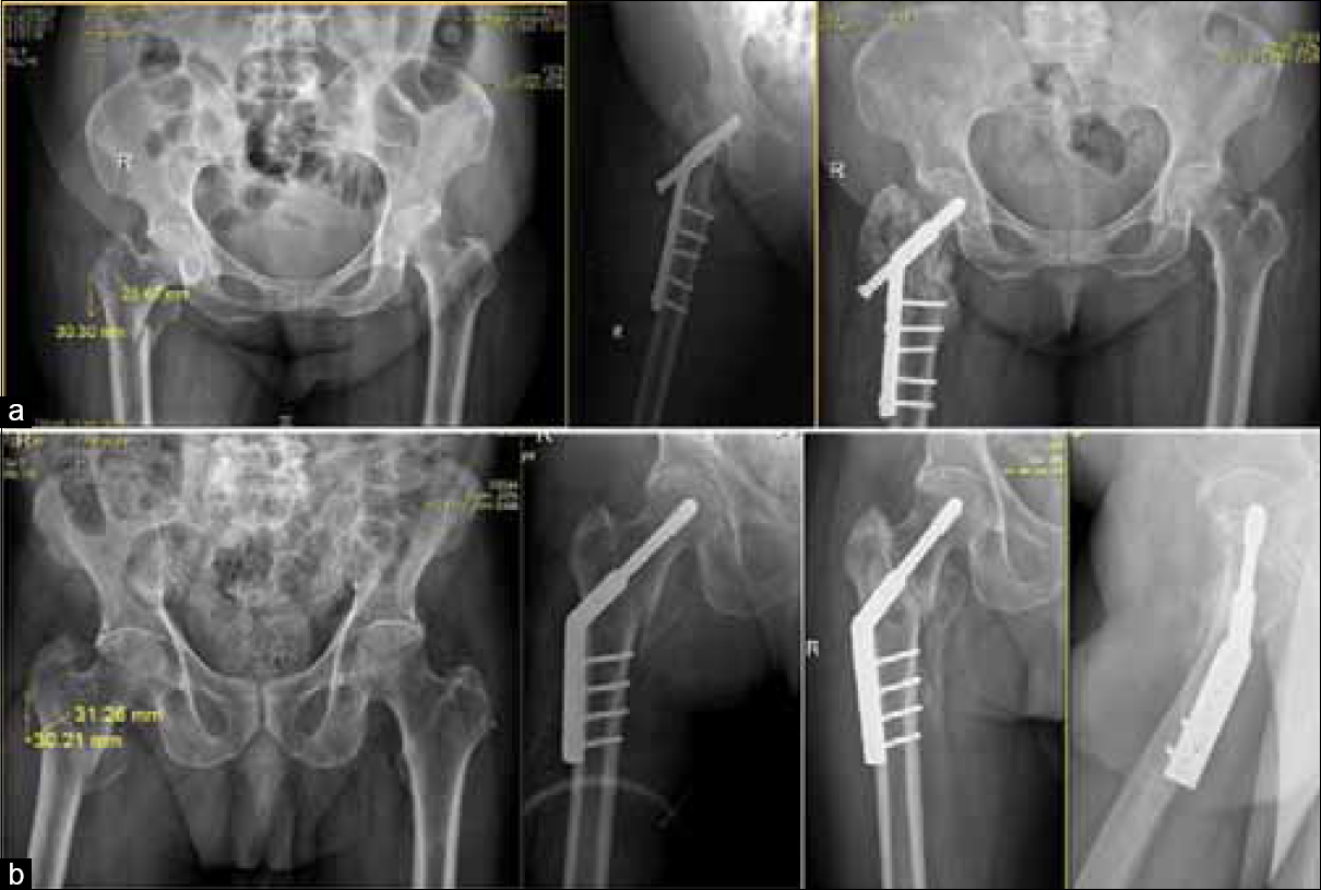 (a) Radiograph of intertrochanteric fracture which collapsed but united (3 months postoperative). (b) Radiograph of intertrochanteric fracture which united without collapse (>3 months postoperative)