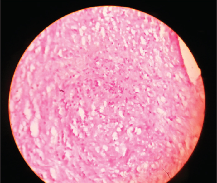 Histopathology of ganglionic tissue