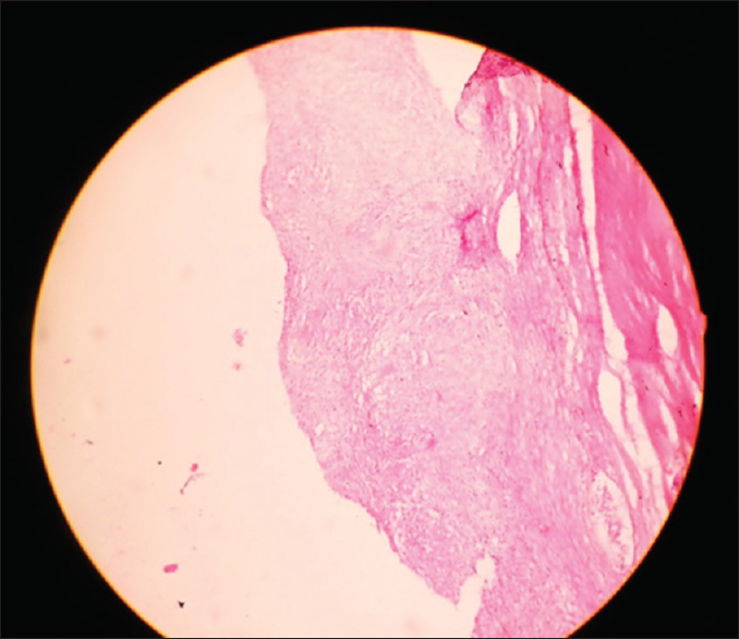 Histopathology of ganglionic tissue magnified view