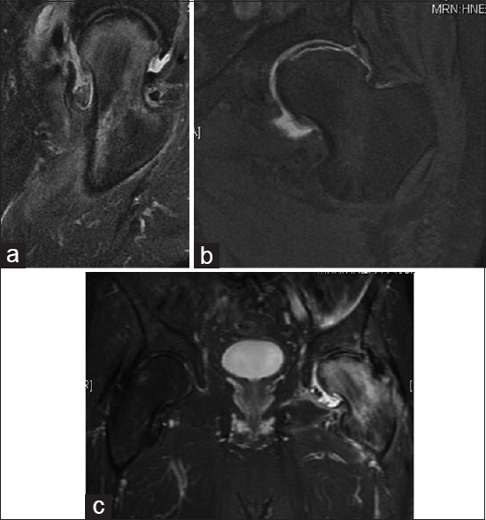 The study revealed a large area of avascular necrosis of the left femoral head, associated with subchondral collapse. Reactive edema present and a large articular cartilage delamination of the femoral head. (a) Axial, T2-weighted image. (b) Coronal, T1-weighted image. (c) Coronal, T2-weighted image