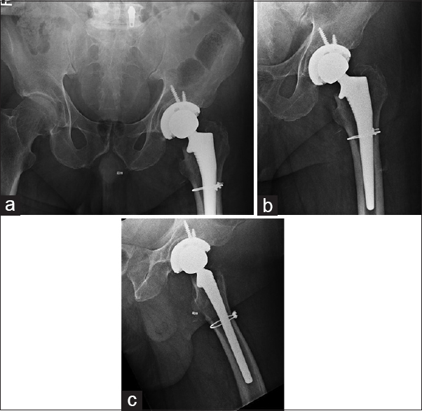 Postoperative images of left cementless total hip arthroplasty with cable augmentation. (a) Anteroposterior pelvis X-ray, (b) anteroposterior left hip X-ray, (c) lateral hip X-ray