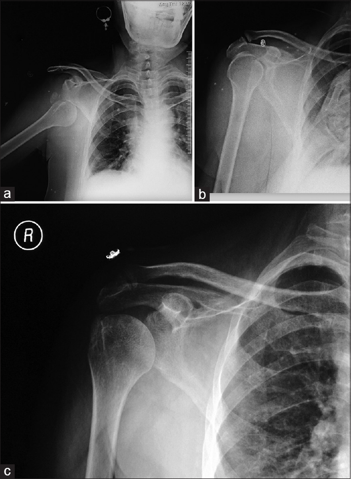 Radiograph of right inferior dislocation with greater tuberosity fracture (a), immediate postreduction (b), and follow-up with united fracture (c)