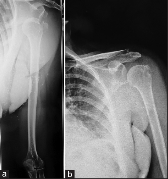 Radiograph of right inferior dislocation with greater tuberosity fracture (a) and follow-up with united fracture (b)