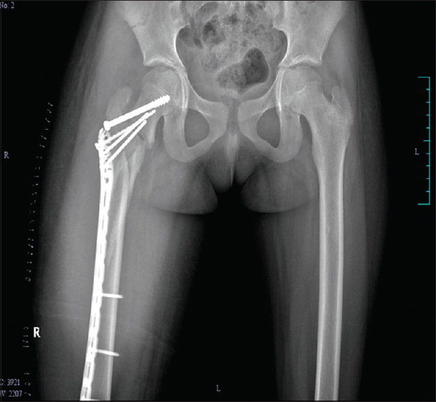 Radiograph of pelvis with both hips showing fracture fixed with PHILOS plate and partially threaded screw