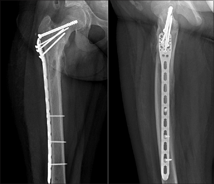 Radiograph of pelvis with both hips showing implant in situ with uniting fracture at 3 months postoperatively