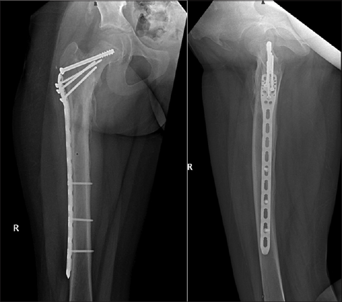 Radiograph of pelvis with both hips showing implant in situ with uniting fracture at 10 months postoperative