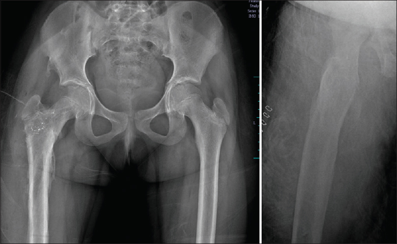 Radiograph of pelvis with both hips after implant removal