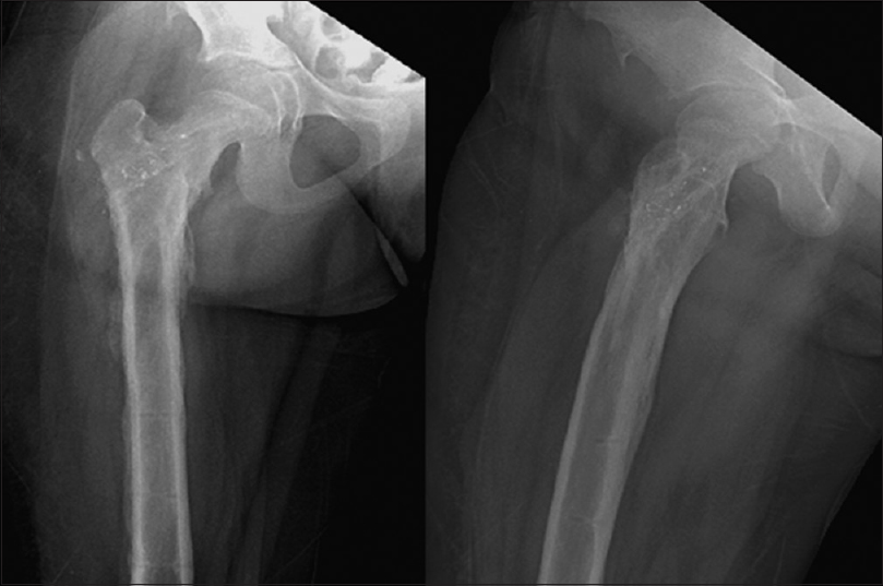 Radiograph of pelvis with both hips till last follow.up at 14. months after implant removal