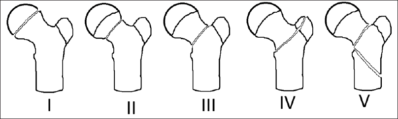 Modified Delbet's classification: Type-I-transepiphyseal with (type IB) or without (type IA) dislocation of the femoral head from the acetabulum; Type-II-transcervical; Type-III-basicervical (cervicotrochanteric); Type-IV-intertrochanteric (Pertrochanteric); and Type-V-cervicotrochanteric with subtrochanteric extension