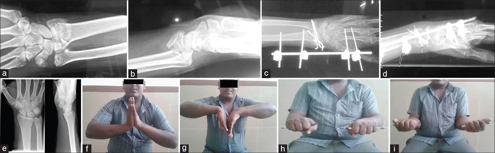 (a) Case series - 1: Preoperative anteroposterior view. (b) Case series – 1: Preoperative lateral view. (c) Case series – 1: Postoperative anteroposterior view. (d) Case series – 1: Postoperative lateral view. (e) Case series – 1: Union 16 weeks. (f) Case series – 1: Dorsiflexion at 2 months. (g) Case series – 1: Palmar flexion at 2 months. (h) Case series – 1: Pronation at 2 months. (i) Case series – 1: Supination at 2 months