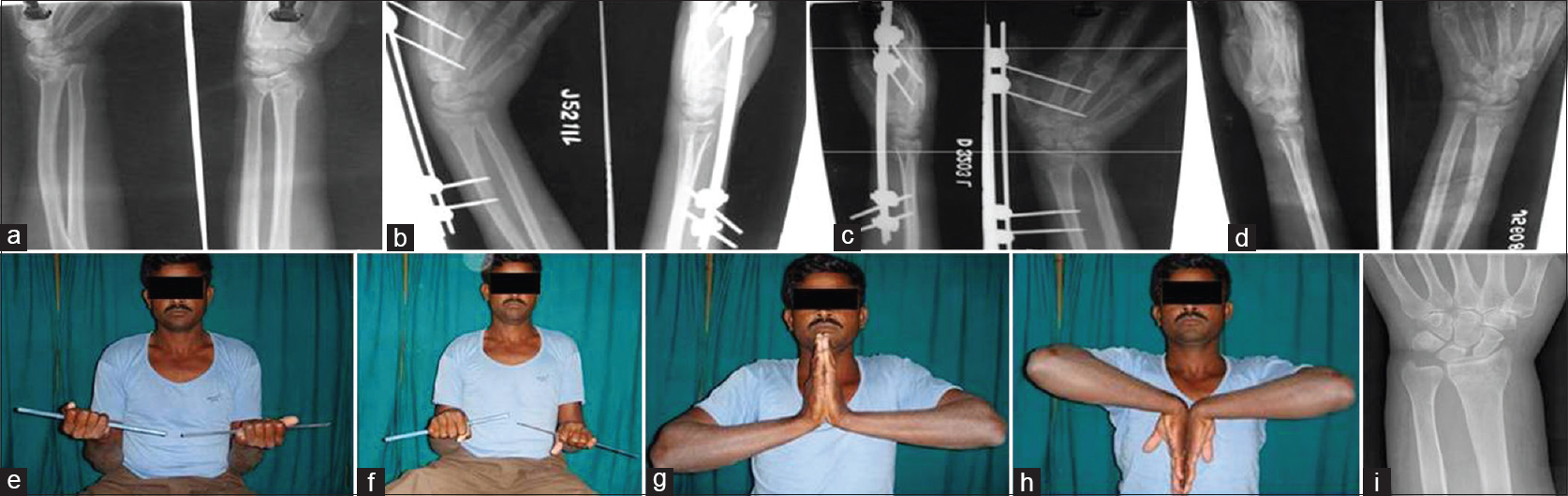 (a) Case series – 2: Preoperative anteroposterior and lateral views. (b) Case series – 2: Postoperative anteroposterior and lateral views. (c) Case series – 2: Postoperative 6 weeks. (d) Case series – 2: Postoperative 3 months. (e) Case series – 2: Supination at 3 months. (f) Case series – 2: Pronation at 3 months. (g) Case series – 2: Dorsiflexion at 3rd month. (h) Case series – 2: Palmar flexion at 3rd month. (i) Case series – 2: X-ray showing fracture union