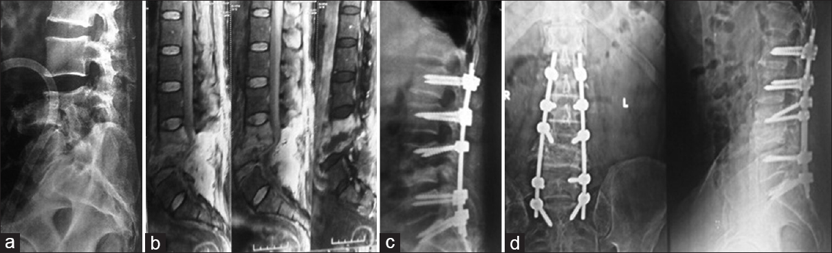 (a) X-ray of 60-year-old male patient with L3–L4 spondylodiscitis. (b) Magnetic resonance imaging showing pre and paravertebral pus collection. (c) X-ray lateral view showing fixation at the level and two levels above and below. (d) Eight months follow-up X-ray showing consolidation