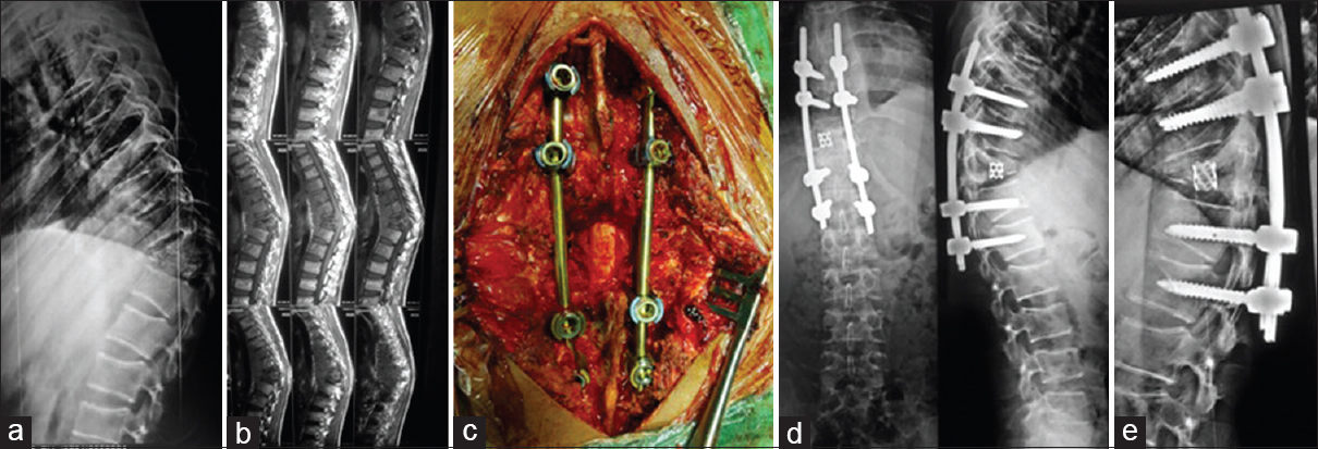 (a) A 16-year-old male patient, D-10 D-11 tuberculosis. (b) Sagittal section of magnetic resonance imaging. (c) Debridement, decompression, and pedicle screw fixation two levels proximal and distal with cage and bone graft done. (d) Postoperative X-ray. (e) Postoperative X-ray follow-up X-ray at 12 months