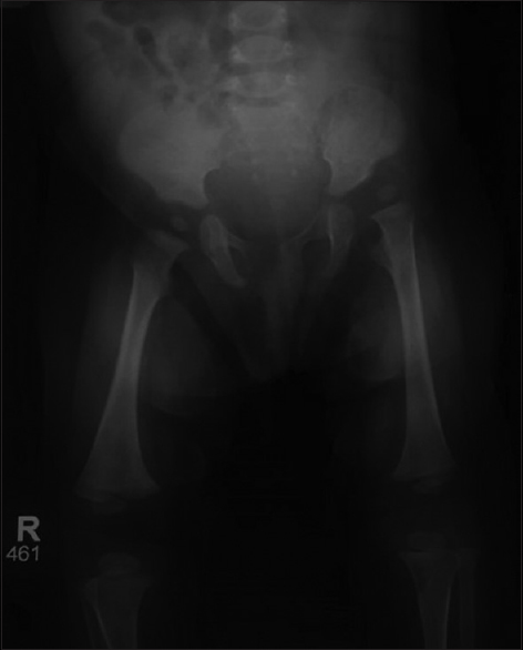 X-ray of pelvic and both hips' anteroposterior view at 3 months