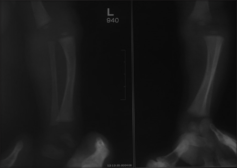 X-ray of the left knee at 2 weeks after birth