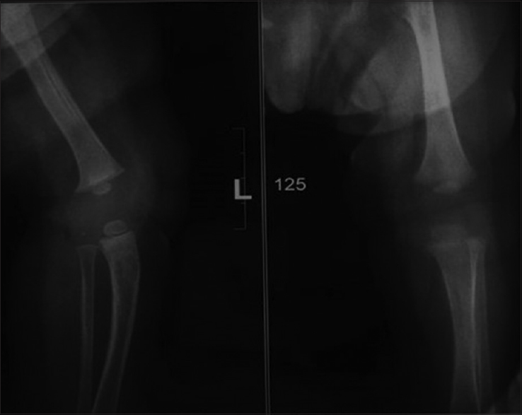 X-ray of the left knee at 3 months