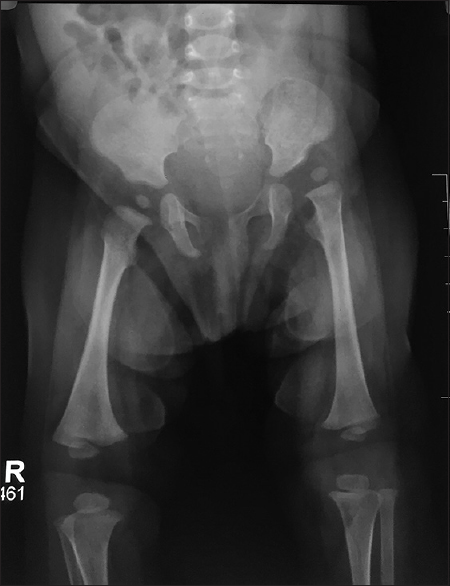 X-ray of pelvic and both hips' anterior view at 3 months