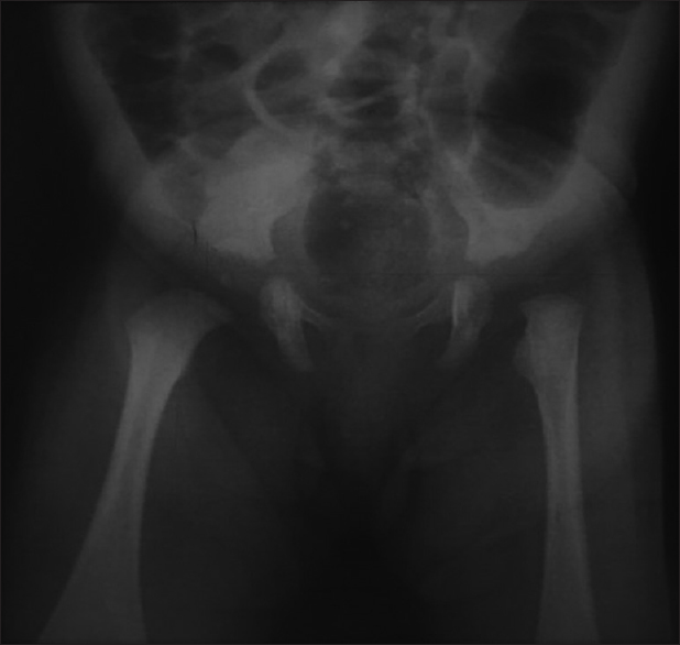 X-ray of pelvic and both hips' anterior view showing developmental dysplasia of the left hip