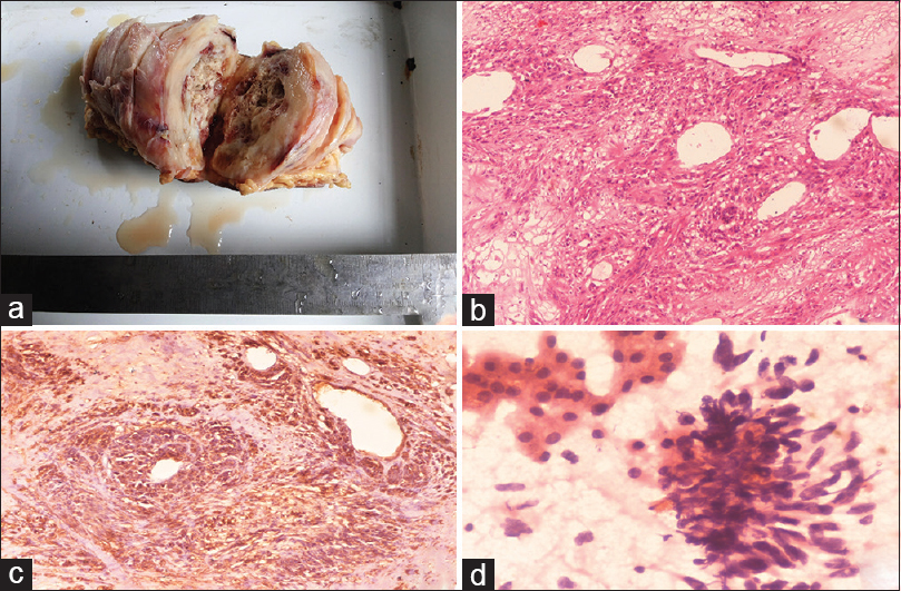 (a) Gross examination showed well-defined encapsulated globular tissue with cut section having necrotic and cystic areas. (b) H and E section (×10) showed spindle-shaped cells with formation of sheets and whorls at places. Perivascular accentuations of tumor cells were also present. (c) Immunohistochemistry was positive for S-100 in the tumor cells (×10). (d) Fine-needle aspiration cytology from the liver (×10) showed malignant spindle cells scattered along with the normal hepatocytes