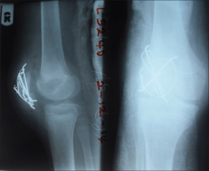 Immediate postoperative radiographs showed the tension band wire device and a step at the patella articular surface