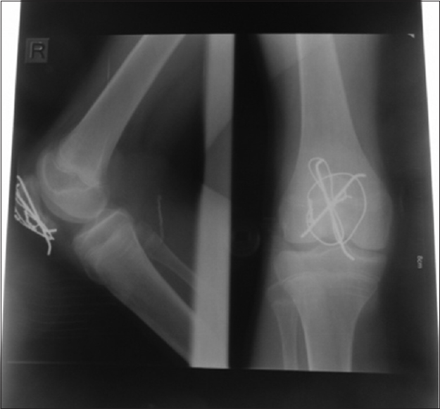 Thirty-four weeks postoperative radiographs showed remodeled patella articular surface step