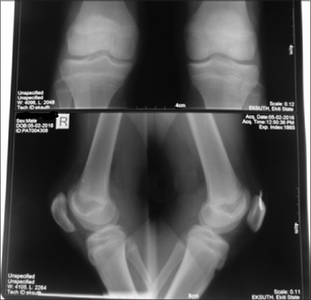 Radiographs of both knees, 60 weeks posttension band wire showed complete remodeled patella articular surface step