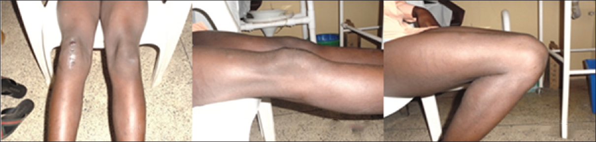 Sixty weeks postoperative showed patient knees in full extension and flexion