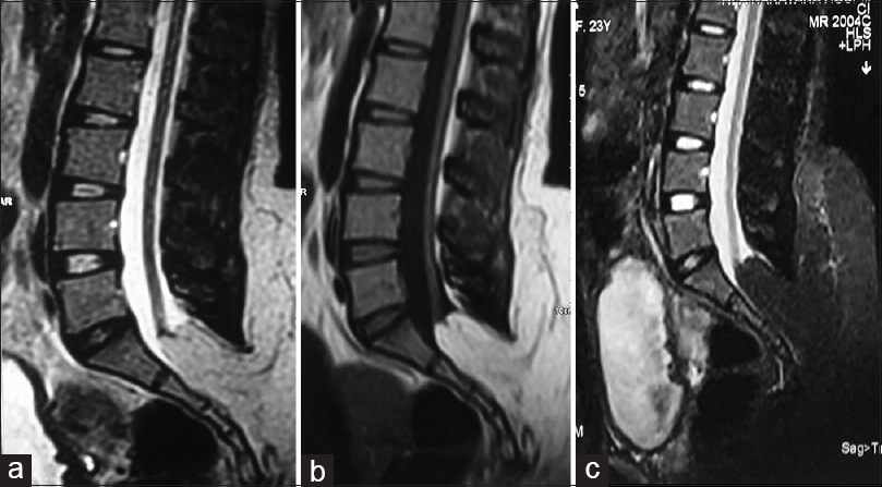 Magnetic resonance imaging lumbar spine showing low-lying cord and extensive lipoma arising from low-lying conus (a) T2-weighted image, (b) T1-weighted image, and (c) fat suppression image