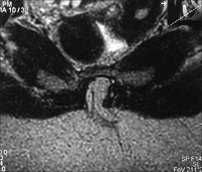 Magnetic resonance imaging lumbar spine fat suppression image showing continuation of the filum terminale as a lipoma into the subcutaneous tissue