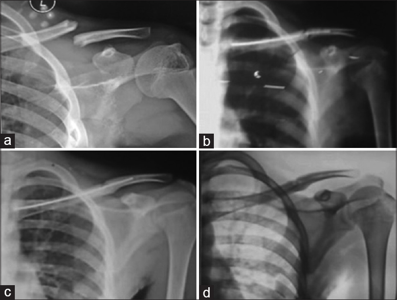 Skiagrams of left clavicle of a 15–year-old male patient showing (a) clavicle fracture, (b) immediate postoperative X-ray with IM TEN in situ, (c) fracture united 3 months postoperatively, and (d) after implant removal