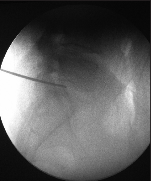 Position of transiliac K wire in lateral view