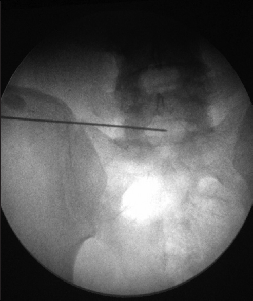 Insertion of 18 G needle through transiliac window AP view