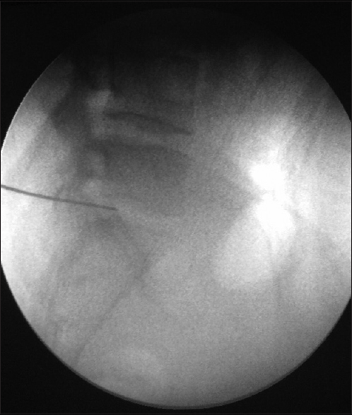 Insertion of 18 G needle through transiliac window lateral view