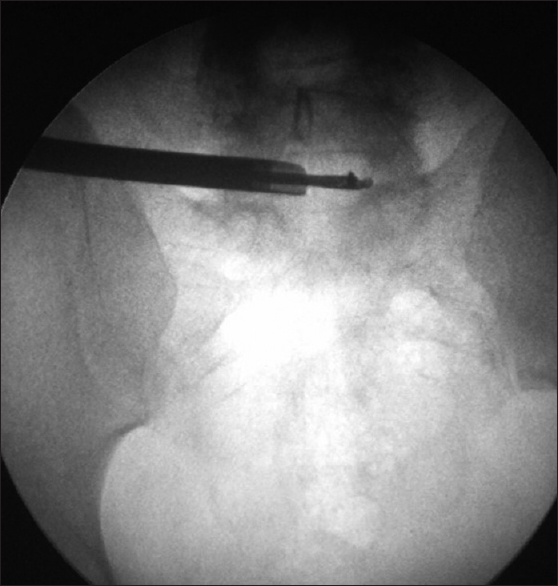 Transiliac endoscopic discectomy