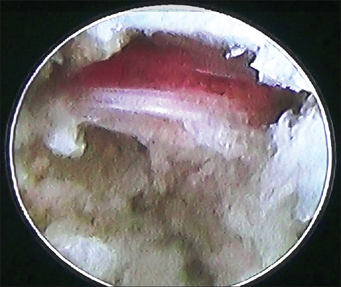 Endoscopic view of decompressed nerve root