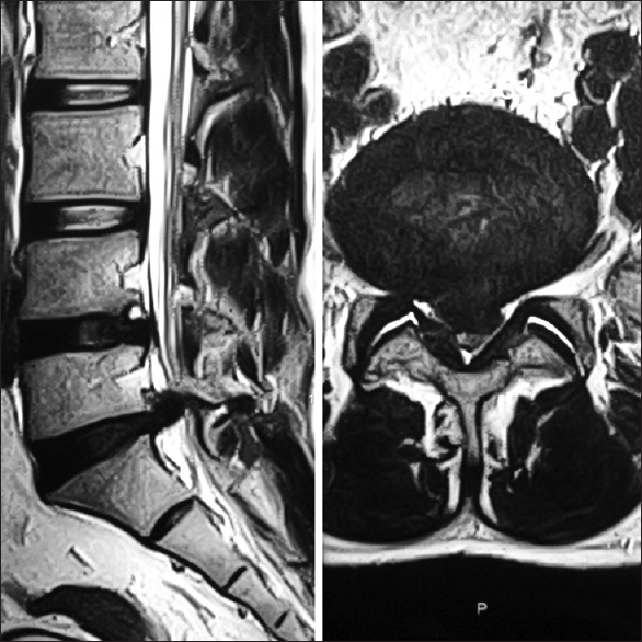 Pre operative MRI scan