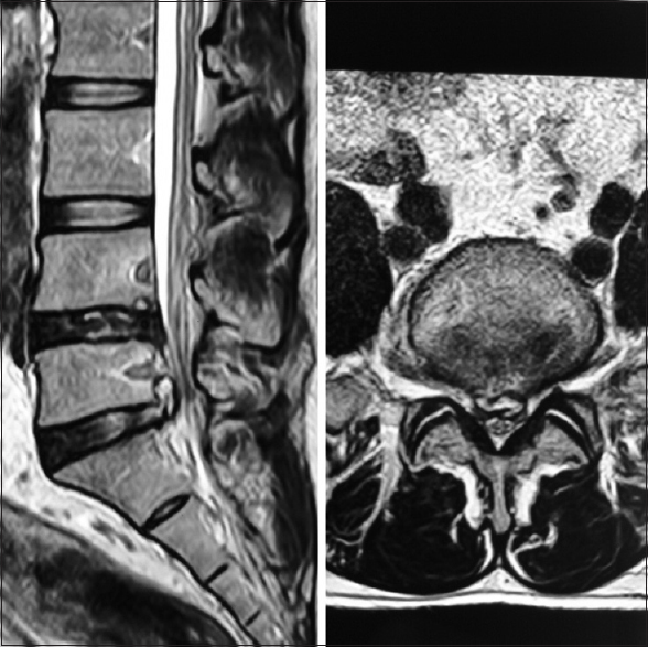 Post operative MRI scan