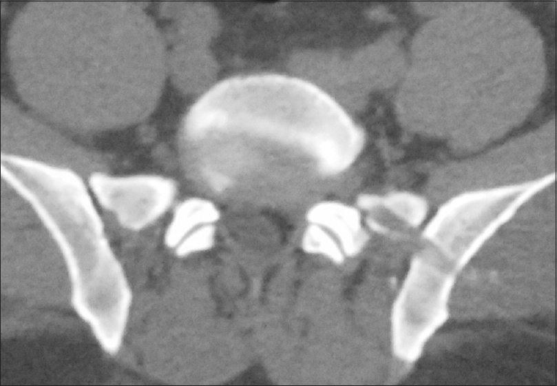 Post operative CT scan showing transiliac window