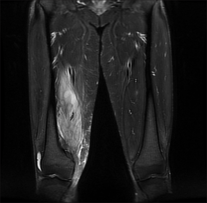 Coronal T2-weighted image showing hyperintense signal changes in the vastus medialis muscle with strong peripheral enhancement and the dimension of the lesion is 2.4 cm × 2 cm × 3.5 cm