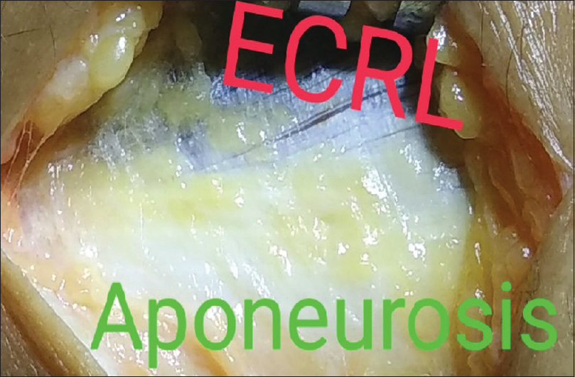 Extensor carpi radialis longus and extensor aponeurosis exposed