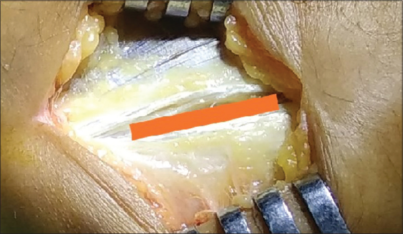 Split between the extensor carpi radialis longus and aponeurosis