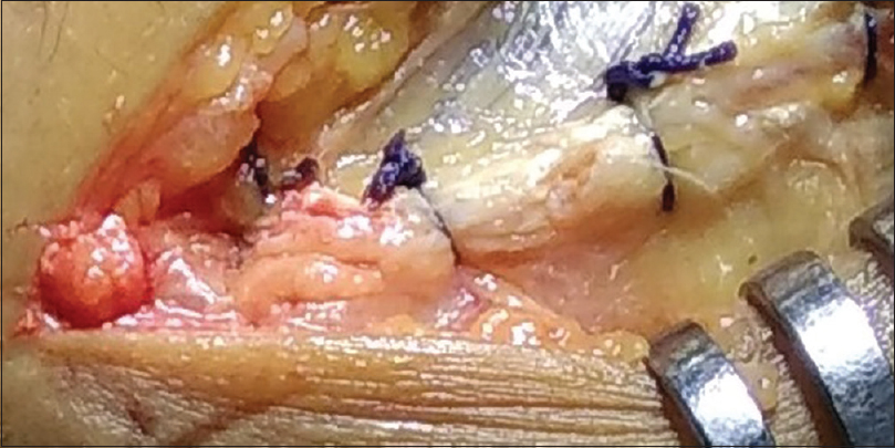 Closure of the extensor carpi radialis longus and aponeurosis