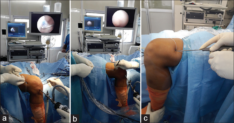 (a) Intraoperative photographs of adjustable loop fixation showing; graft retensioning after tibial tunnel fixation. (b) Making 0.5 cm incision. (c) Knot tying over metal button required as additional surgical steps