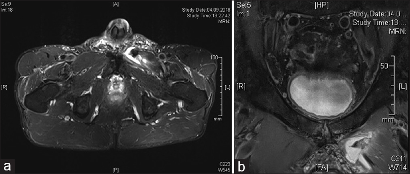 (a and b) Magnetic resonance imaging transversal showing complete osseous avulsion of adductor longus muscle, retraction 8 mm, hematoma