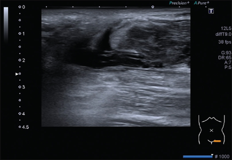 Ultrasonography: Complete avulsion of adductor longus muscle, retracted muscle, hematoma